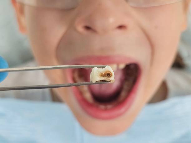 Best Emergency Dental Care for Broken or Chipped Teeth in Woodville, OH