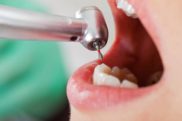 Best Emergency Treatment for Dental Infections or Abscesses in Woodville, OH